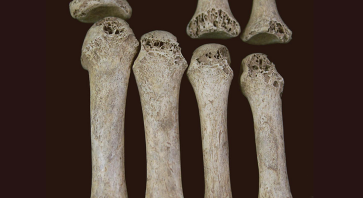 Forskerne har analyseret menneskeknogler fra det 11. til det 18. århundrede. Her ses knogler med benhindebetændelse fra en person med spedalskhed. Foto: Nuria Montes.