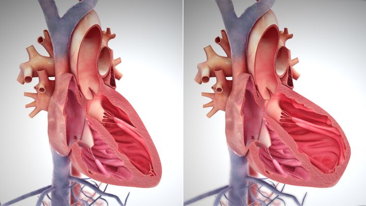 Sundt hjerte med sammentrukket muskel til venstre og svækket hjerte med overstrukket muskel til højre. Kilde: scientificanimations.com, fri afbenyttelse med Creative Commons-licens CC BY-SA 4.0