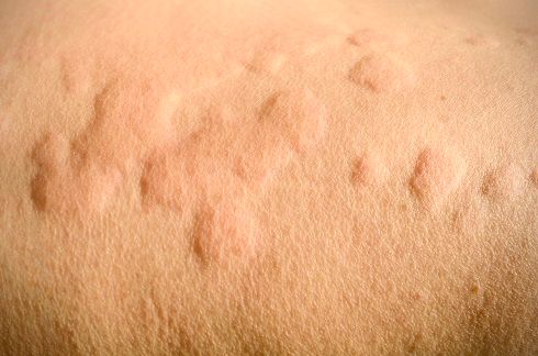 Nældefeber er en almindelig hudsygdom, hvor huden ligner og føles som om, at man har været i kontakt med brændenælder.