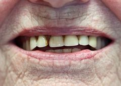 Valget af udenlandske tandproteser fører ofte til dårlige resultater, som efterfølgende skal laves om i Danmark. Foto: PR.