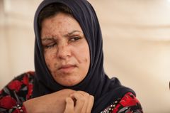 Khadija har stadig smerter på grund af små sprængstykker, som endnu hager sig fast i kroppen. Foto: Peter Eilertsen for Mission Øst.
