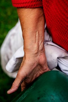 Andrea Rose har fået indopereret titaniumplader i håndleddene efter hun brækkede dem som følge af knogleskørhed. Foto: Anders Clausen
