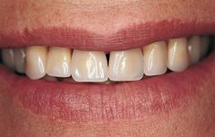 Tandproteser med naturtro tænder og korrekt udførelse giver et naturligt og smukt smil.  Foto: PR.