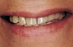 Billige tandproteser genkendes nemt på de ensartede tænder og kunstige udtryk. Foto: PR.