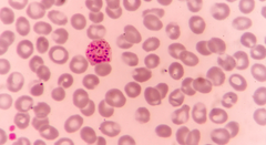 Malariaparasitten ses her i blodlegemerne hos et menneske. Foto: Canva.