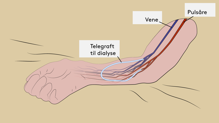 llustration af en telegraft-åre til dialyse indopereret i en arm. Illustration: Mikkel Larris, SDU