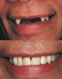Det er ikke kun ældre mennesker, der får kunstige tænder. Også yngre må skifte de gamle ud, ofte på grund af dårligt vedligehold. Foto: PR.