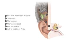 MED-EL Launches World's First Commercially Available Totally Invisible Cochlear Implant Copyright: MED-EL