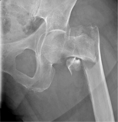 Røntgenfoto af et hoftebrud.