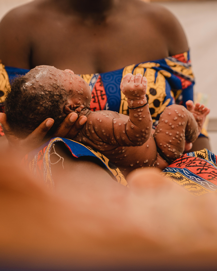 Spædbarn i armene på sin mor i et mpox isolation centeret i DR Congo, Juli 2024.