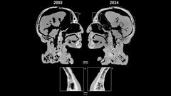 Sammenligning af billederne fra den kliniske scanning i 2002 og billederne fra mikroCTscanningen i 2024. Opløsningen i de nye billeder er 422 gange bedre end i de gamle.