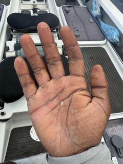 Håndflade med vabler og hård hud.