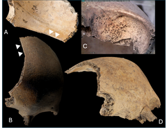 Kranium af barn på 2-4 år fra Aalborg, set fra forskellige vinkler, der viser skaderne efter hug med sværd. Kraniet blev senere nedlagt i gulvet i et hus.