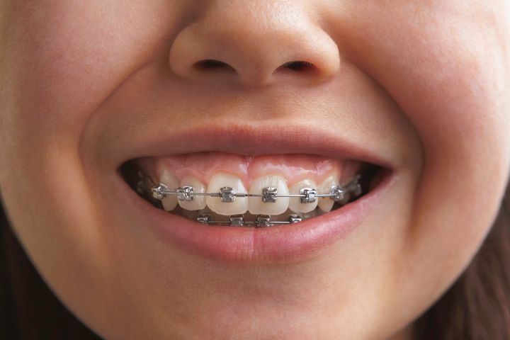 Værktøjet er udviklet ved hjælp af skanningsbilleder af tænder og knoglestrukturer i kæber som en kunstig intelligens bruger til at forudsige, hvordan tandbøjlen skal sidde for at rette tænderne op. Foto: Getty