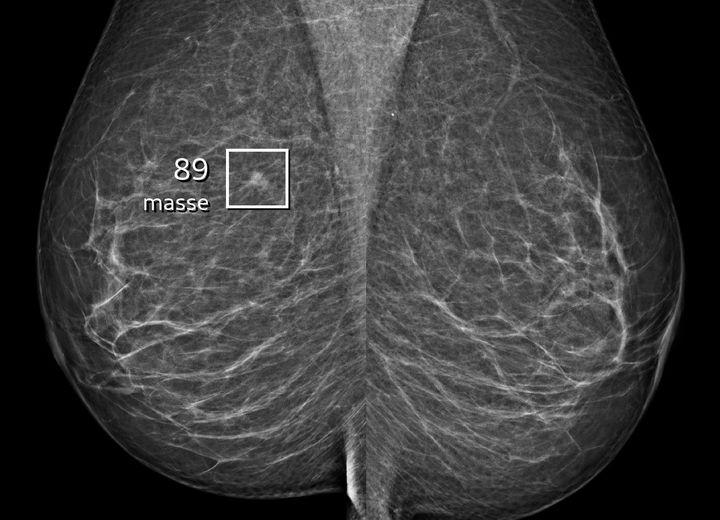 Screeningsmammografi af en 57-årig kvinde, hvor AI automatisk har markeret en mistænkelig læsion med en malignitetsscore på 89/100.  På grund af den høje score, blev mammografien gransket af to brystradiologer, der var enige med AI'en om fundet. Efterfølgende diagnostik påviste en invasiv brystkræft. Foto: Afdeling for brystundersøgelser Herlev Gentofte Hospital