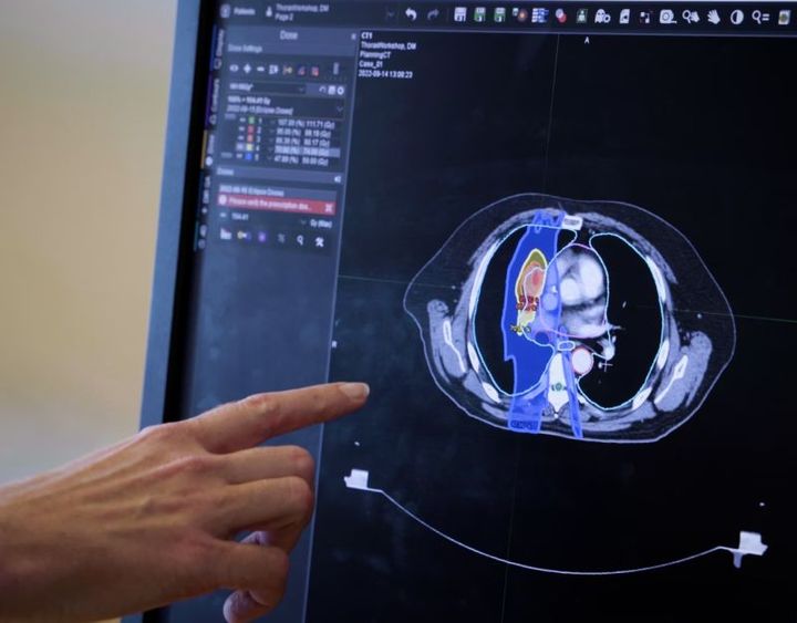 Den midtjyske kræftbehandling løftes med flere medarbejdere, nye arbejdsgange, ny teknologi og hjælp fra kunstig intelligens (AI).