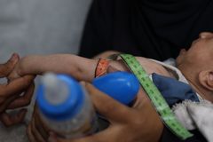 Et barn, der lider af underernæring, er til kontrol på Læger uden Grænsers klinik i Gaza By i juli 2025.