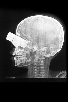 Februar 2026: En ni-årig dreng ankom til hospitalet i Tchad, hvor Læger uden Grænser arbejder, efter at være blevet såret i et droneangreb i det vestlige Sudan. Han havde et stort granatsplintsår i øjet, alvorlige ansigtsbrud og to amputerede fingre. Tine, Tchad.